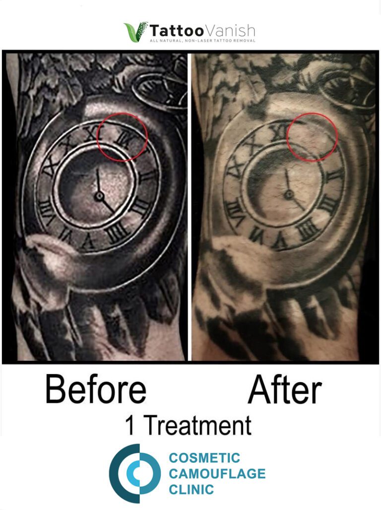 Laser Tattoo Removal Near Me  Cutera Laser Solution  AAYNA