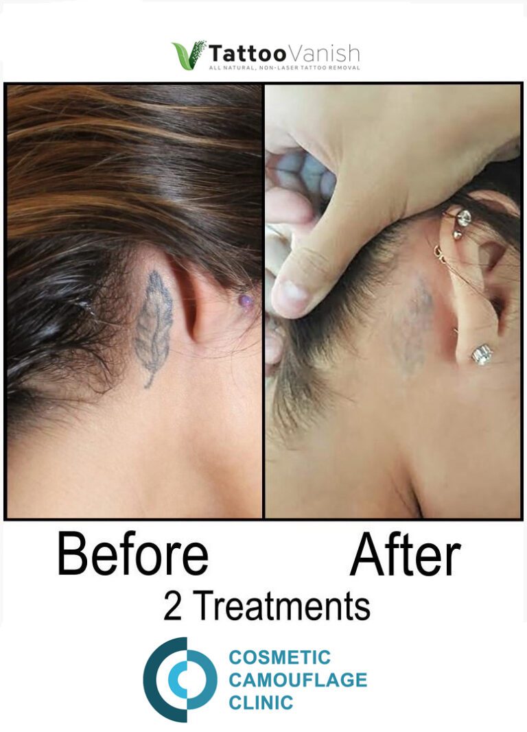 Before and After Tattoo Removal - Get the Best Res (31)