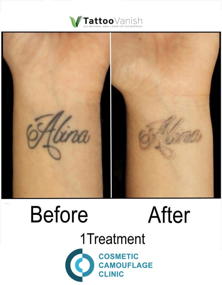 Before and After Tattoo Removal - Get the Best Res (37)