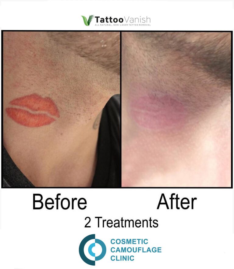 Before and After Tattoo Removal - Get the Best Res (38)