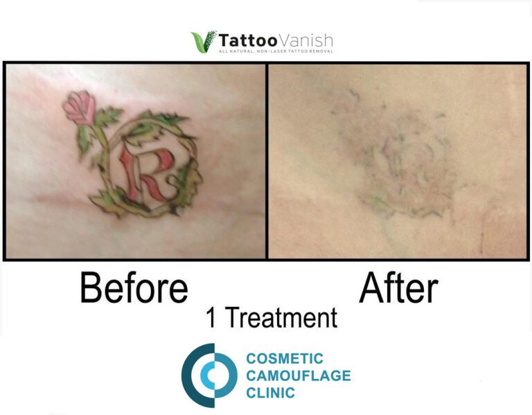 Before and After Tattoo Removal - Get the Best Res (41)