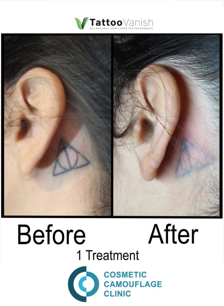 Welcome to Vanish Laser Clinic  Brisbanes Experts in Tattoo Removal  by  Vanish Laser Clinic  Medium