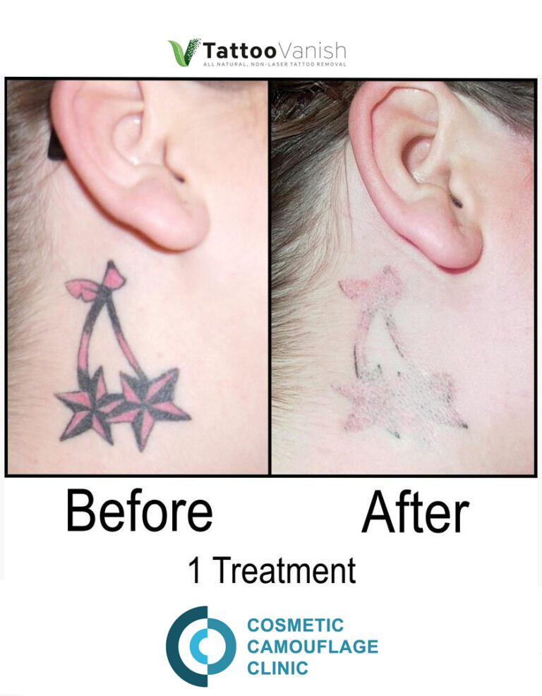 Before and After Tattoo Removal - Get the Best Res