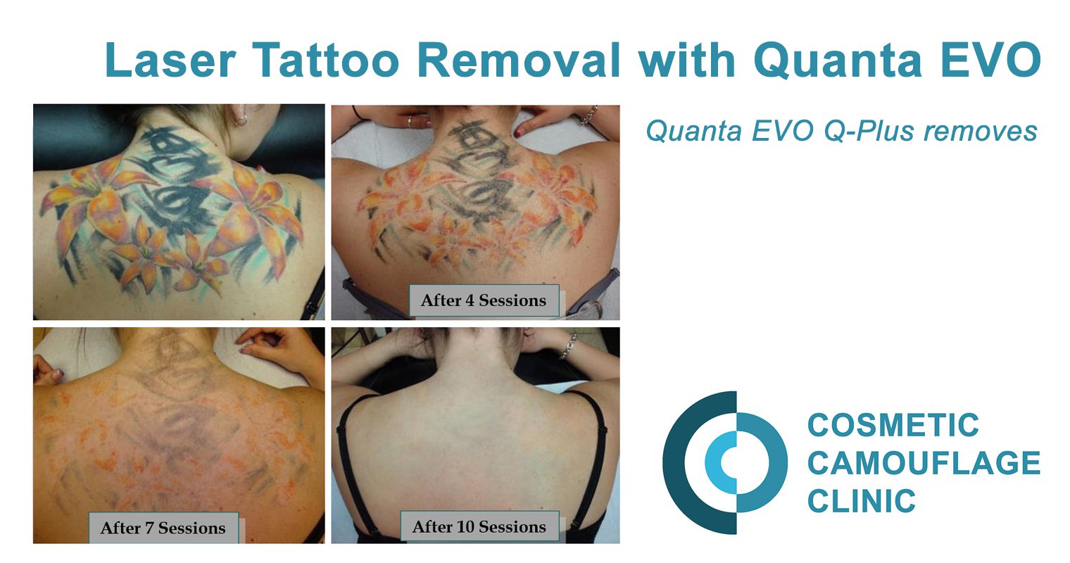Cosmetic Camouflage - Micropigmentation | Tattoo Removal
