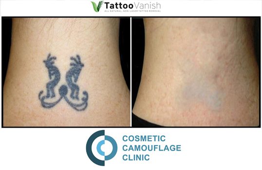 Cosmetic Camouflage - Micropigmentation | Tattoo Removal