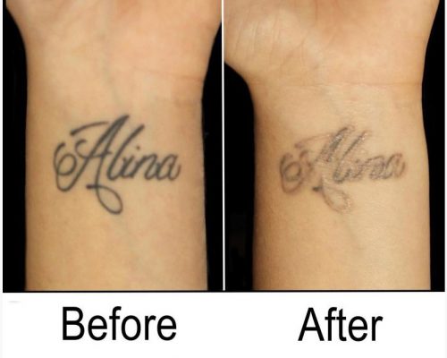 Before and After Tattoo Removal – Get the Best Res (37) Before and After Tattoo Removal - Get the Best Res (37)